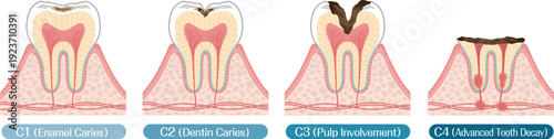 Progression of Tooth Decay C1 to C4 Dental Caries Stages Illustration