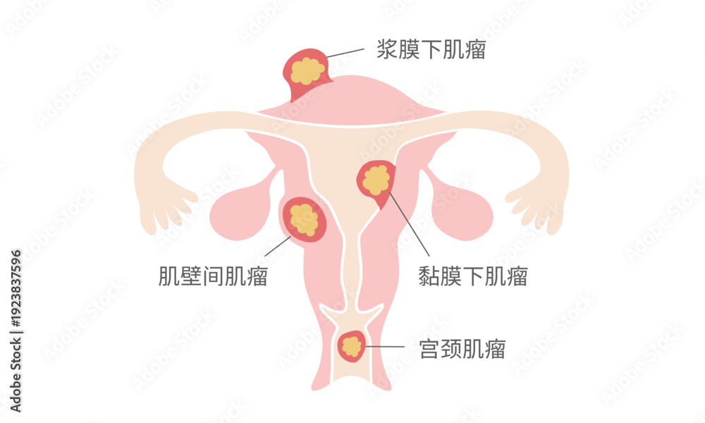 Fototapeta premium 子宫肌瘤类型图解 – 肌壁间肌瘤、黏膜下肌瘤、浆膜下肌瘤、宫颈肌瘤
