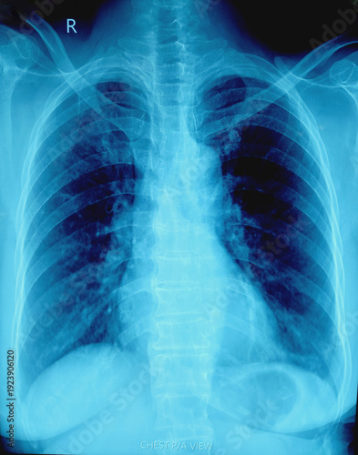 Cuadro en lienzo X-ray of human chest. Suggestive of pneumonitis.