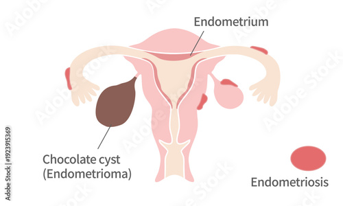 Medical Illustration of Endometriosis and Chocolate Cyst – Female Reproductive System