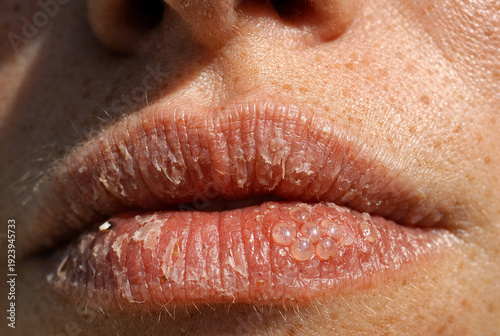 Close-up of lips showing dryness, cracking, and clustered fluid-filled blisters on lower lip, characteristic of herpes simplex virus outbreak. Medical representation highlights cold sore symptoms.