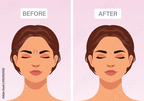 Age-related skin changes between eyebrows Illustration before and after facial transformation, wrinkle reduction, skin smoothing. For skin care, anti-aging product, facial massage, cosmetic procedures