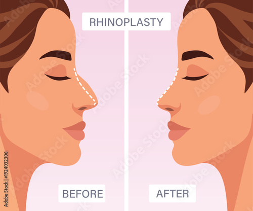 Rhinoplasty. Vector illustration, rhinoplasty before and after. Profile woman highlights change shape nose. Medical design for advertising cosmetic surgeries, websites, social media, plastic surgery