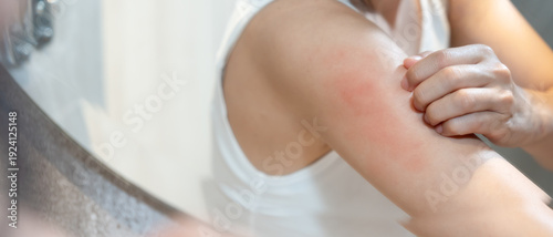 skin problem and beauty. woman scratch body has itchy skin from skin allergic, steroid allergy, sensitive skin, red from sunburn, chemical allergy, rash, insect bites, Seborrheic Dermatitis.