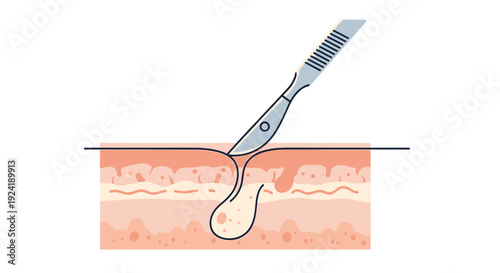 A medical illustration showing a cross-section of skin layers with a scalpel performing a minor surgical procedure to remove a boil or cyst.