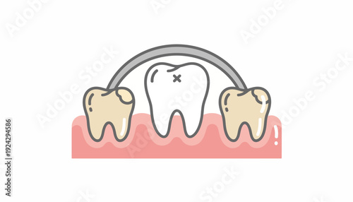 Dental bridge illustration with missing tooth and adjacent teeth.