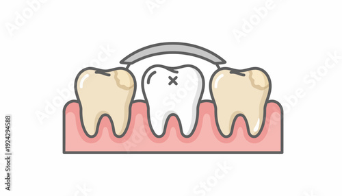 Dental illustration of a tooth with a dental bridge or crown.