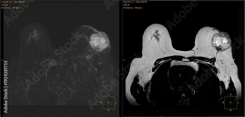 Cuadro en lienzo Image of breast tumor obtained with MRI