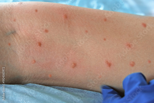 Photos Doctor examining child with bodily red rash
