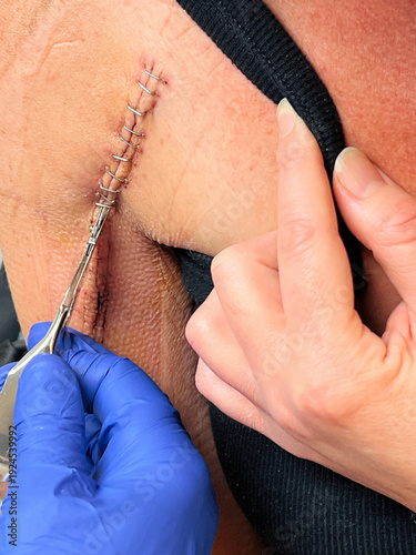 Medical staple Removal from Surgery Incision