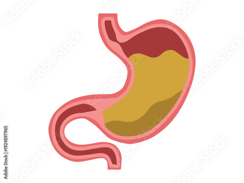 Gastroparesis Disease in Stomach Illustration