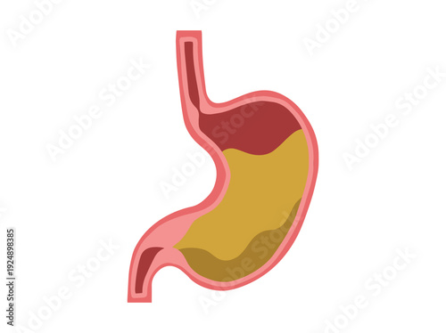 Gastroparesis Disease in Stomach Illustration