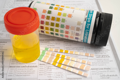 Cuadro en lienzo Urinalysis, urine cup with reagent strip pH paper test and comparison chart in laboratory