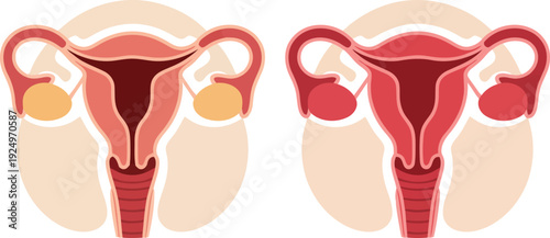 Comparative anatomical diagrams illustrate a healthy female reproductive system alongside one with ovarian cysts