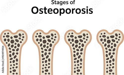 Medical graphic depicting the middle stages of osteoporosis with increasing bone deterioration and porosity