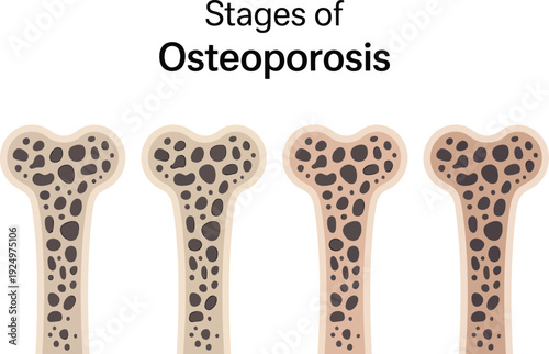 Medical illustration showing the early stages of osteoporosis with four bone cross sections