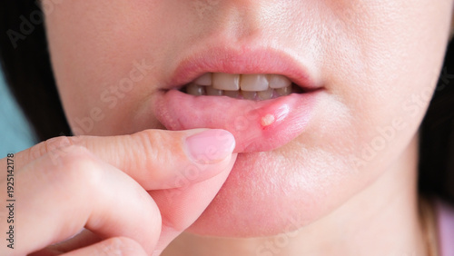 A woman has stomatitis on her lip