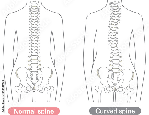 Spinal Alignment Comparison Normal vs Curved Spine Illustration