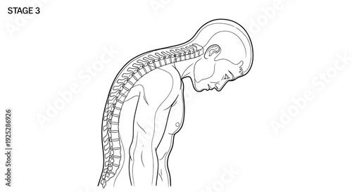 Human Spine Illustration Showing Stage 3 Curvature.