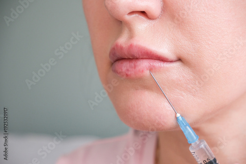A woman gets hyaluronic acid injected into her lips.