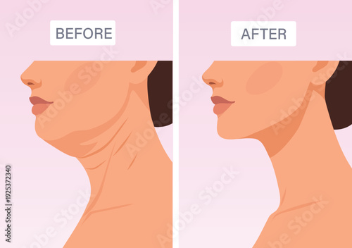 Double chin. Vector illustration before and after, changing profile of the face, reducing wrinkles on the neck, double chin. For cosmetic procedures, skin care products advertising, anti-aging product