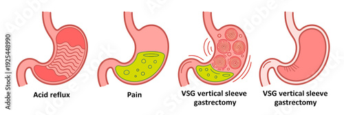 Anatomical illustrations of stomachs with various conditions and surgical procedures