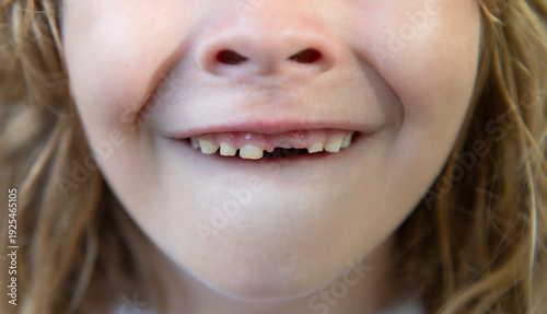Tableau sur toile Smiling child with missing teeth