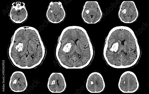 CT scan brain image showing intracerebral hemorrhage stroke