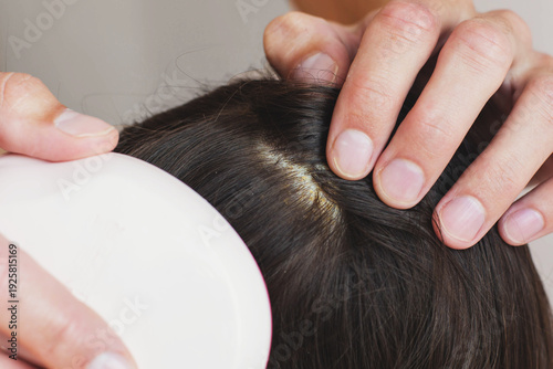 Foto Close up view of dark brown hair with visible dandruff flakes  seborrheic dermat