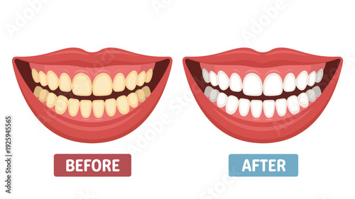 Dental care illustration showing before and after teeth whitening treatment on a dental model from a close-up frontal viewpoint