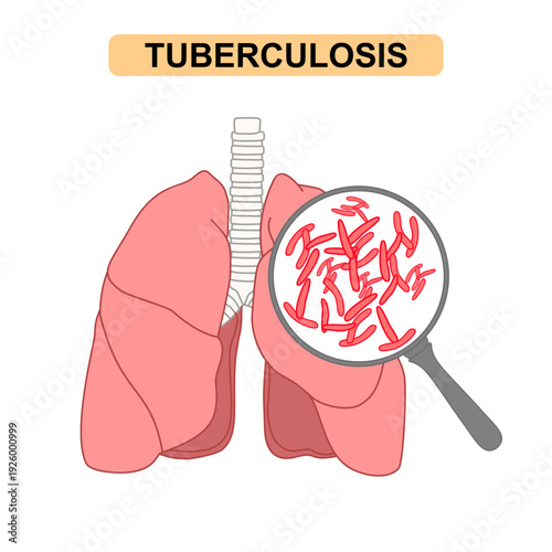 Pulmonary Tuberculosis concept with Mycobacterium Under Magnification, lung disease concept. vector illustration for, health element design, medical awareness campaign, education, and medical poster
