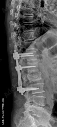 Lumbar spine X-ray with spinal fusion hardware
