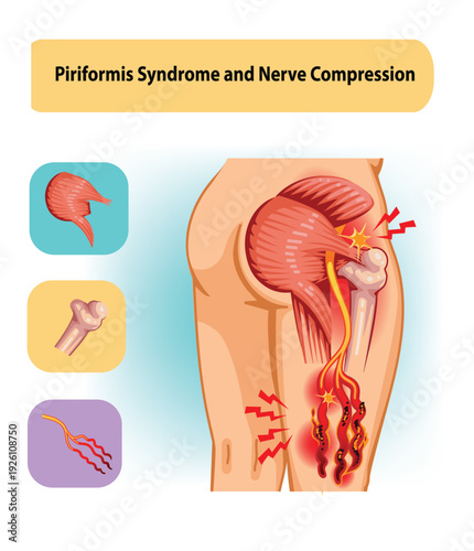 Piriformis Syndrome with Sciatic Nerve Compression Diagram