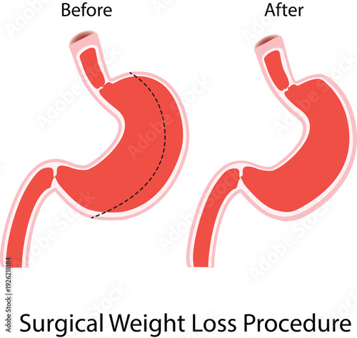 Surgical Weight Loss Procedure Science Design Vector Illustration Diagram