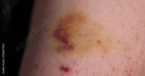 a man's arm with bruises from a blow, the damaged part of a man's arm with red and yellow bruises and healing scratches