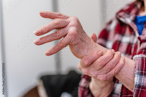 An elderly woman with rheumatoid arthritis on her hands, joint damage