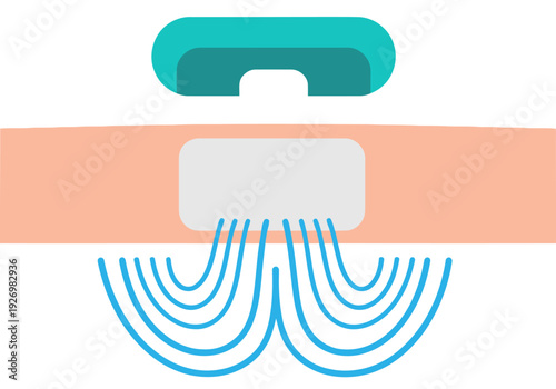 Illustration depicts a Continuous Glucose Monitor (CGM) sensor transmitting data. A stylized sensor is placed on the body with lines representing the data stream. Modern, clean design.