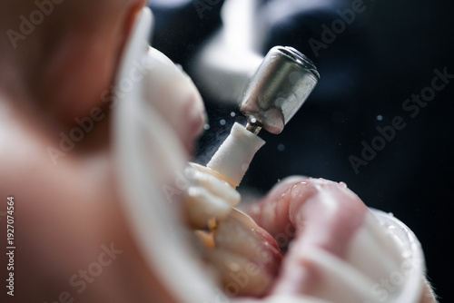 Fotografi Dental Drill Polishing Molar Close Up, Gloved Hand Shaping Composite Resin Under