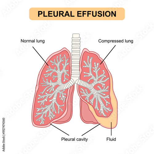 Medical illustration of lung disease pleural effusion. Fluid in the lungs. Fluid accumulation in the lung cavity. Vectors for medical, respiratory diseases, educational, and posters.