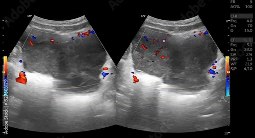 Transabdominal ultrasound imaging of the uterus demonstrates a well-defined intrauterine mass with internal vascularity on color Doppler evaluation, suggestive of a solid uterine lesion requiring furt