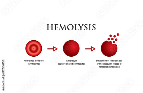 Hemolysis. Normal red blood cell, spherocyte, then destruction of red blood cell with subsequent release of hemoglobin into blood. Vector illustration