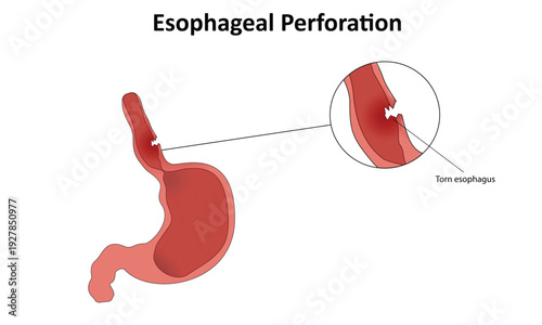 Esophageal perforation vector illustration