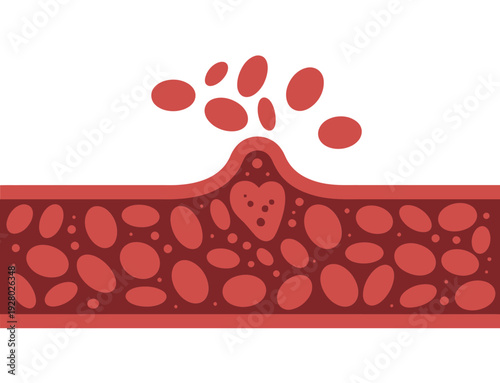Illustration depicting blood vessel damage and leaking red blood cells