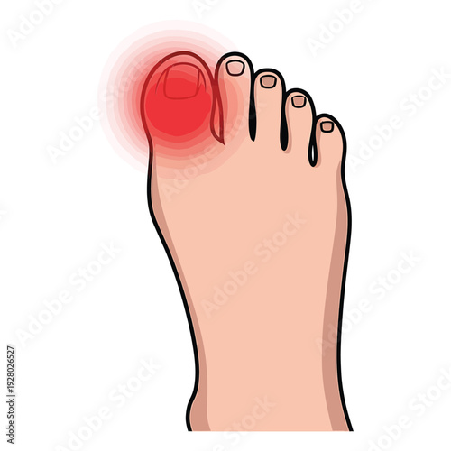 Illustration of a human foot with a highlighted and inflamed big toe joint