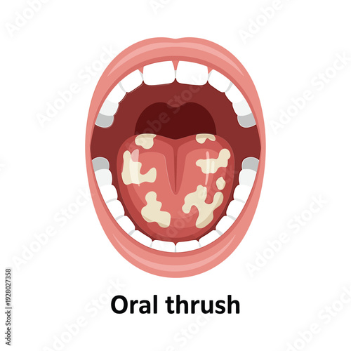 An illustration depicting an open mouth showing signs of oral thrush infection