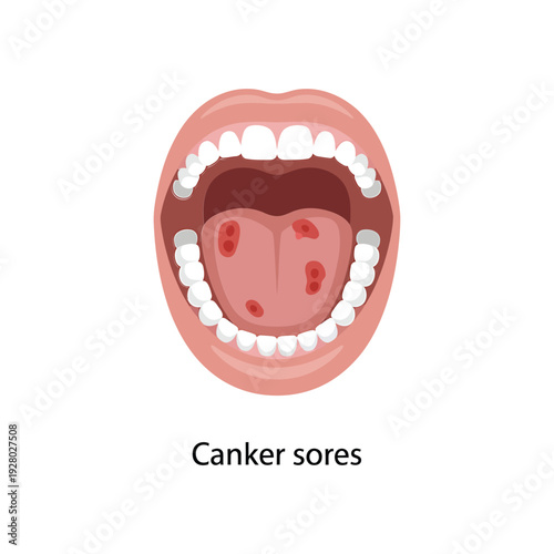 Illustration of an open mouth showing tooth enamel and canker sores inside