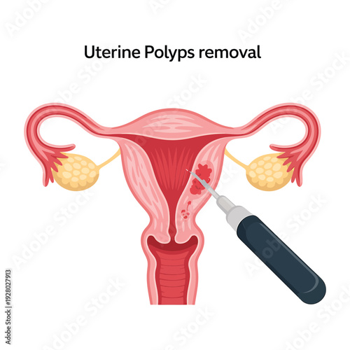 Medical illustration depicting the removal of uterine polyps from a woman s uterus