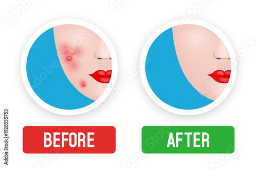 Acne skin and clear skin. Before and after. Vector illustration.