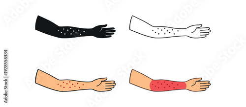 Human forearm with rash dots scattered across skin surface for allergic reaction icon set four styles: black solid silhouette thin black outline flat colored anatomical illustration and