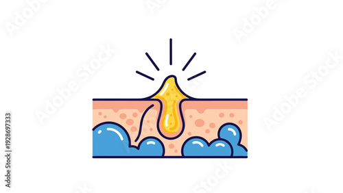 Medical illustration of a skin pore becoming clogged with sebum and bacteria leading to the formation of an acne pimple or blemish.